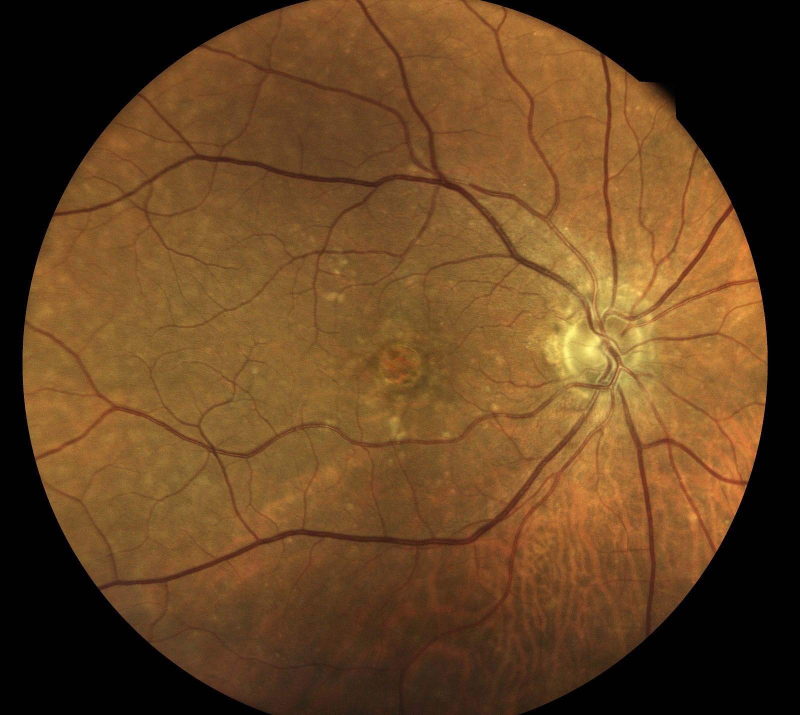 Angiogenesi Oculare